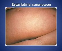 Image result for Exantema Escarlatiniforme