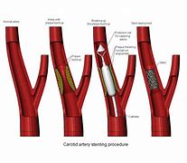 Image result for Carotid Artery Stenting Procedure