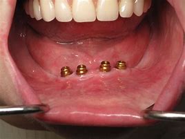 Image result for What Is an Implant Locator