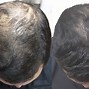 Image result for Minoxidil Before and After Pics