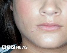Image result for Mumps