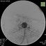 Image result for CT Angiogram Neck