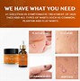 Image result for Warts On Hands Treatment