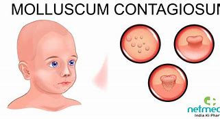 Image result for Molluscum Contagiosum Rash