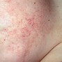 Image result for Itchy Burn