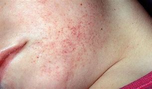 Image result for Skin Cancer Rash