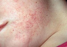 Image result for Leukemia Skin Symptoms