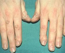 Image result for Different Kinds of Warts On Hands