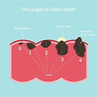 Image result for Bowel Cancer Stages