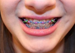 Image result for Braces for Kids