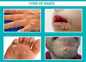 Image result for Different Types of Hand Warts