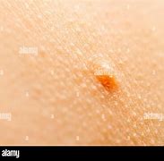 Image result for Water Warts