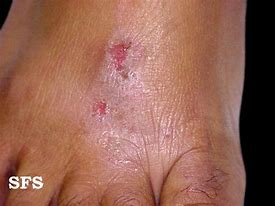 Image result for Contact Dermatitis Genital Area