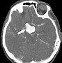 Image result for Ruptured Carotid Artery Aneurysm