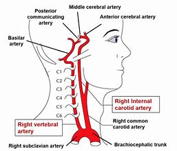 Image result for Vertebral Arteris and Carotid Arteries