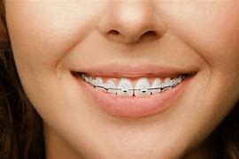 Image result for Invisible Braces for Adults