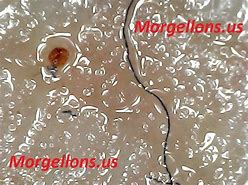 Image result for Fake Morgellons