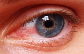 Image result for Pic of Computer Eye Strain