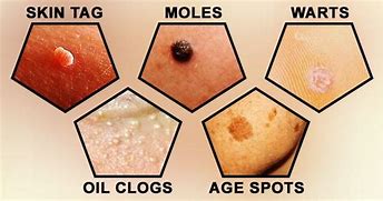 Image result for Skin Tags vs Genital Warts