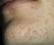 Image result for Flat Warts