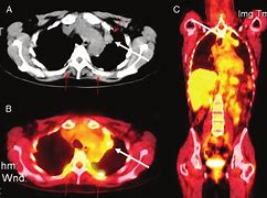 Image result for Pet Scan Lung