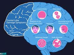 Image result for Frontal Lobe Syndrome