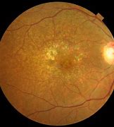 Image result for White Spots On Retina
