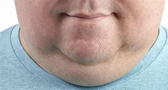 Image result for Double Chin or Goiter
