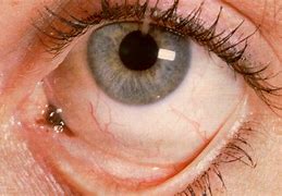Image result for Conjunctival Mass