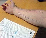 Image result for Anaphylactic Allergic Reaction