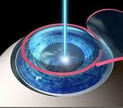 Image result for Eye Surgery