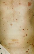 Image result for Gonorrhea On Skin