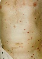 Image result for Cutaneous Gonorrhea