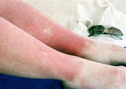 Image result for Sun Poisoning