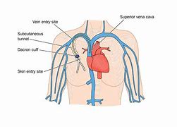 Image result for Central Venous Catheter Placement Procedure