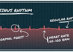 Image result for Sinus Rhythm with U Wave