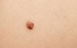 Image result for Mole Genital Warts