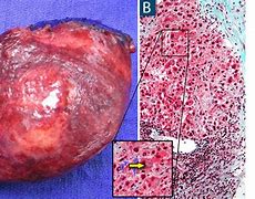 Image result for How Big Is a 12 Cm Tumor