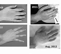 Image result for hand transplant