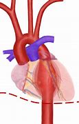 Image result for Thoracic Aortic Aneurysm