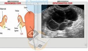 Image result for Management of Adnexal Cyst