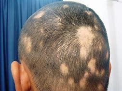 Image result for alopecia