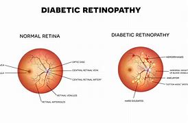 Image result for Diabetes Retina