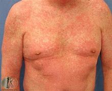 Image result for Calcium Eruptions in Skin