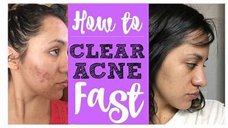 Image result for People with Clear Skin