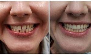 Image result for Invisalign Images