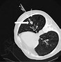 Image result for Pulmonary Nodule X-ray