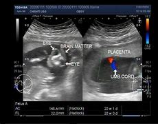 Image result for Anencephaly Neural Tube