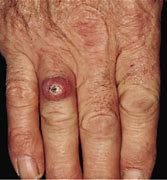 Image result for Cutaneous Nodules