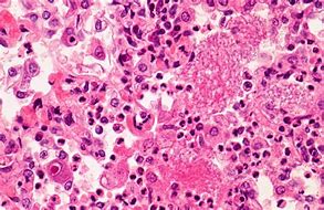 Image result for Pneumocystis Carinii Pneumonia